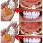 Teeth whitening in just 2 minutes – turning yellow and accumulated tartar into milk-like white