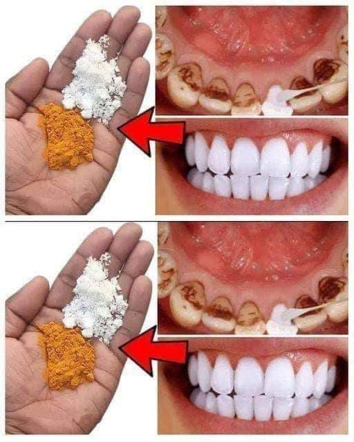 Teeth whitening in just 2 minutes – turning yellow and accumulated tartar into milk-like white