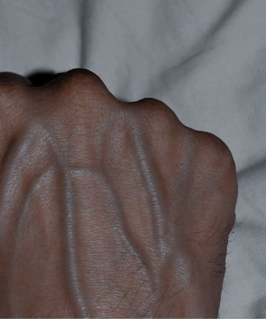 If your veins are visible in your hand, it is a signal of ca…