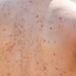 What Causes Acne