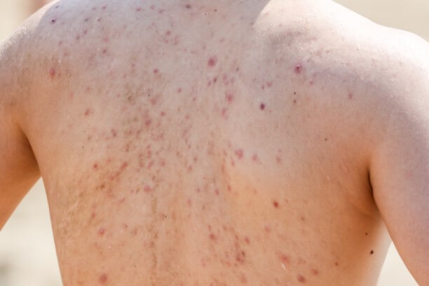 What Causes Acne