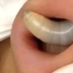 DON’T WATCH THIS Fly larvae penetrate the skin (not even Chuck Norris could stand it) *