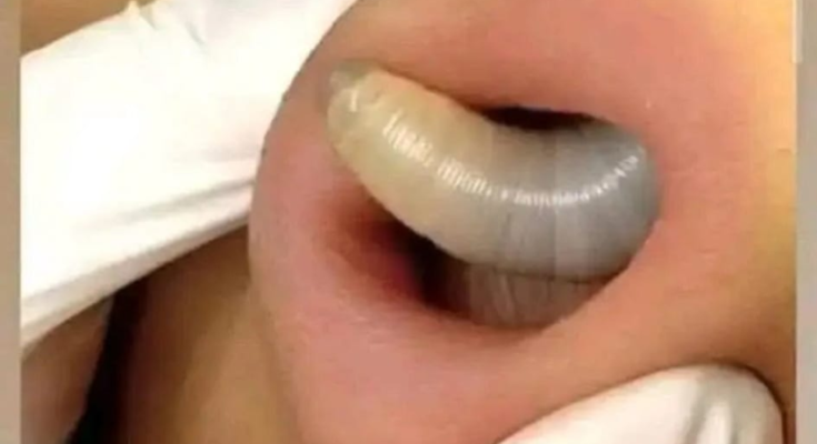 DON’T WATCH THIS Fly larvae penetrate the skin (not even Chuck Norris could stand it) *
